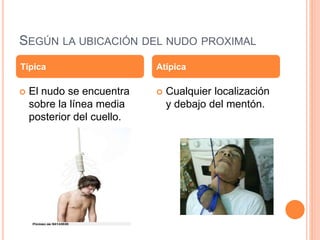 SEGÚN LA UBICACIÓN DEL NUDO PROXIMAL
 El nudo se encuentra
sobre la línea media
posterior del cuello.
 Cualquier localización
y debajo del mentón.
Típica Atípica
 