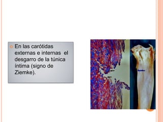  En las carótidas
externas e internas el
desgarro de la túnica
íntima (signo de
Ziemke).
 
