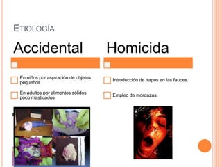ETIOLOGÍA
Accidental
En niños por aspiración de objetos
pequeños
En adultos por alimentos sólidos
poco masticados.
Homicida
Introducción de trapos en las fauces.
Empleo de mordazas.
 