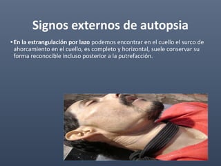 Signos externos de autopsia
•En la estrangulación por lazo podemos encontrar en el cuello el surco de
ahorcamiento en el cuello, es completo y horizontal, suele conservar su
forma reconocible incluso posterior a la putrefacción.
 