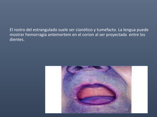 El rostro del estrangulado suele ser cianótico y tumefacto. La lengua puede
mostrar hemorragia antemortem en el corion al ser proyectada entre los
dientes.
 