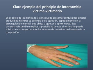 Claro ejemplo del principio de intercambio
victima-victimario
En el dorso de las manos, la victima puede presentar contusiones simples
producidas mientras se defendía de la agresión, especialmente en la
estrangulación manual, que obliga a agresor a aproximarse. Esta
circunstancia también explica la posibilidad de que el victimario pueda
sufrirlas en las suyas durante los intentos de la victima de liberarse de la
compresión.
 