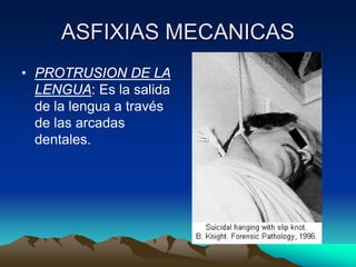 ASFIXIAS MECANICAS
• PROTRUSION DE LA
  LENGUA: Es la salida
  de la lengua a través
  de las arcadas
  dentales.
 