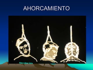 AHORCAMIENTO
 