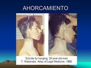 AHORCAMIENTO
 