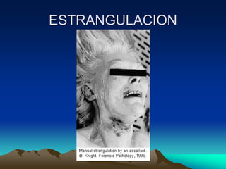 ESTRANGULACION
 