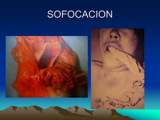 SOFOCACION
 