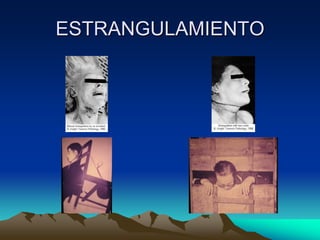 ESTRANGULAMIENTO
 