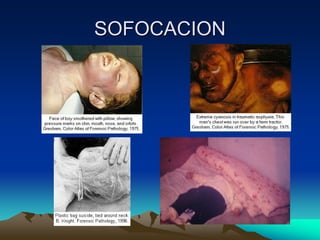 SOFOCACION
 