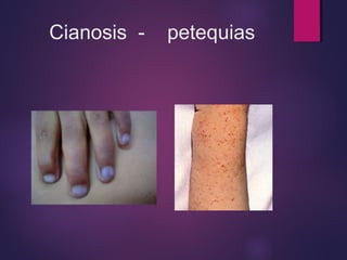 Cianosis - petequias 
 