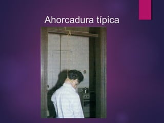 Ahorcadura típica 
 