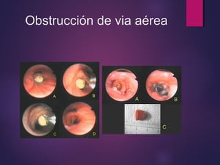 Obstrucción de via aérea 
 
