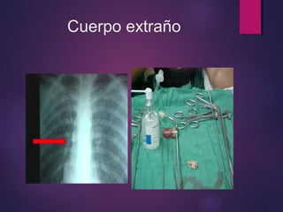 Cuerpo extraño 
 