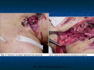 DR. PERCY HUANCAPAZA CH. 31
 