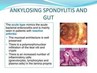 Ankylosing Spondylitis the gut and the bugs: an integrative approach to treatment