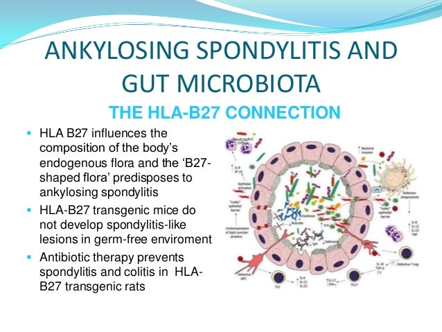 Ankylosing Spondylitis the gut and the bugs an