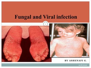 B Y A S H E N A F I G .
12/8/2022
1
Fungal and Viral infection
 