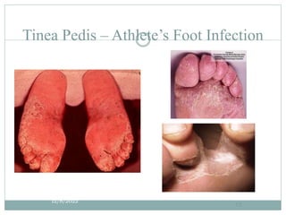 Tinea Pedis – Athlete’s Foot Infection
12/8/2022
13
 