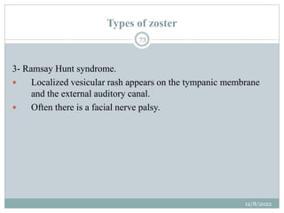 Types of zoster
3- Ramsay Hunt syndrome.
 Localized vesicular rash appears on the tympanic membrane
and the external audi...