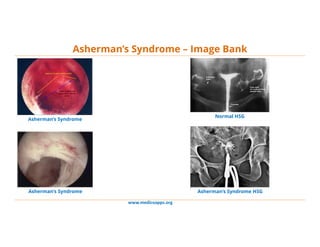 www.medicoapps.org
Asherman’s Syndrome – Image Bank
Asherman’s Syndrome
Asherman’s Syndrome
Normal HSG
Asherman’s Syndrome HSG
 