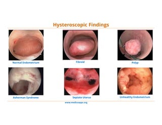 www.medicoapps.org
Hysteroscopic Findings
Normal Endometrium Fibroid Polyp
Unhealthy EndometriumSeptate UterusAsherman Syndrome
 
