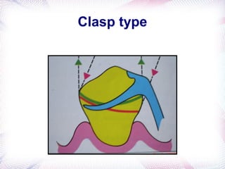 biomechanics in rpd | PPT