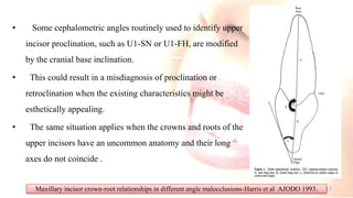 • Some cephalometric angles routinely used to identify upper
incisor proclination, such as U1-SN or U1-FH, are modified
by the cranial base inclination.
• This could result in a misdiagnosis of proclination or
retroclination when the existing characteristics might be
esthetically appealing.
• The same situation applies when the crowns and roots of the
upper incisors have an uncommon anatomy and their long
axes do not coincide .
Maxillary incisor crown-root relationships in different angle malocclusions-Harris et al AJODO 1993. 17
 
