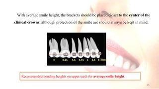 With average smile height, the brackets should be placed closer to the center of the
clinical crowns, although protection of the smile arc should always be kept in mind.
Recommended bonding heights on upper teeth for average smile height.
25
 