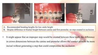 • It might appear that an improper step would be created between these teeth, the difference
in crown dimensions between the canine and premolar allows the contact point to be more
incisal without generating a step that could compromise the occlusion .
A. Recommended bonding heights for low smile height
B. Despite difference in bracket height between canine and first premolar, no step created in occlusion.
27
 