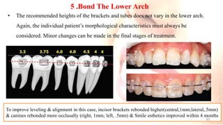 5 .Bond The Lower Arch
• The recommended heights of the brackets and tubes does not vary in the lower arch.
Again, the individual patient’s morphological characteristics must always be
considered. Minor changes can be made in the final stages of treatment.
To improve leveling & alignment in this case, incisor brackets rebonded higher(central,1mm;lateral,.5mm)
& canines rebonded more occlusally (right, 1mm; left, .5mm) & Smile esthetics improved within 4 months
30
 