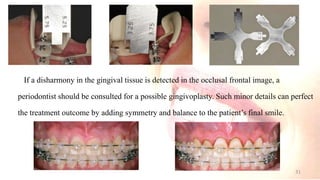 If a disharmony in the gingival tissue is detected in the occlusal frontal image, a
periodontist should be consulted for a possible gingivoplasty. Such minor details can perfect
the treatment outcome by adding symmetry and balance to the patient’s final smile.
31
 