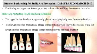 Bracket Positioning for Smile Arc Protection –Dr.PITTS JCO/MARCH 2017
• Positioning the upper brackets to protect or enhance the smile arc has come to be called
Smile Arc Protection (SAP) bracket positioning.
• The upper incisor brackets are generally placed more gingivally than the canine brackets.
• The lower posterior brackets are placed somewhat gingivally to avoid occlusion, while the
lower anterior brackets are placed somewhat incisally to optimize overbite.
32
 