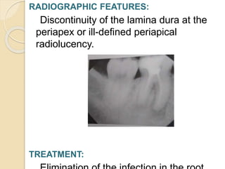 RADIOGRAPHIC FEATURES:
Discontinuity of the lamina dura at the
periapex or ill-defined periapical
radiolucency.
TREATMENT:
 