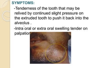 SYMPTOMS:
-Tenderness of the tooth that may be
relived by continued slight pressure on
the extruded tooth to push it back into the
alveolus .
-Intra oral or extra oral swelling tender on
palpation .
-
 