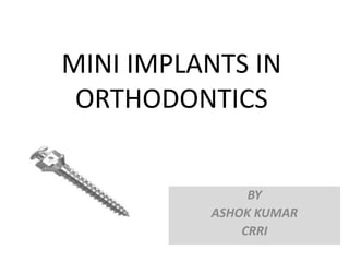 MINI IMPLANTS IN
ORTHODONTICS
BY
ASHOK KUMAR
CRRI
 