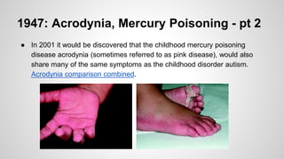 1947: Acrodynia, Mercury Poisoning - pt 2
● In 2001 it would be discovered that the childhood mercury poisoning
disease acrodynia (sometimes referred to as pink disease), would also
share many of the same symptoms as the childhood disorder autism.
Acrodynia comparison combined.
 