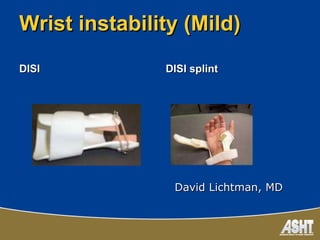 Asht-ca chapter splinting | PPT