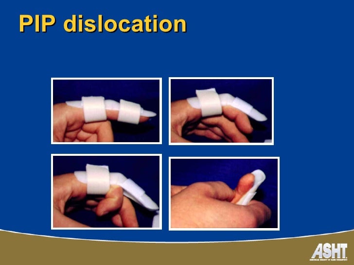 Ashtca chapter splinting