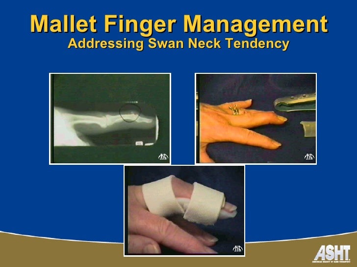 Ashtca chapter splinting