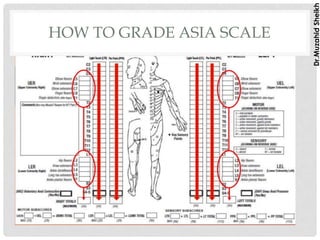 ASIA SCALE FOR SPINAL CORD INJURY ASSESSMENT | PDF