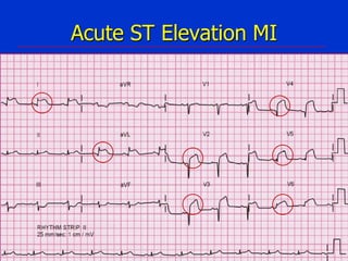 Acute ST Elevation MI

 