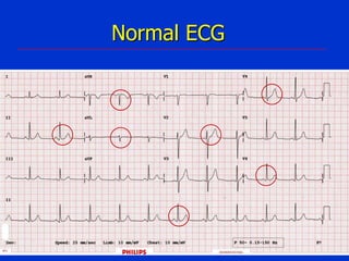 Normal ECG

 