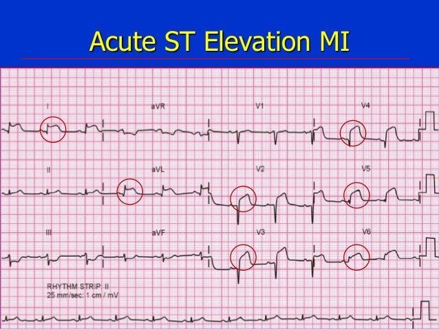 acute coronary syndrome nstemi st elevation myocardial infarction