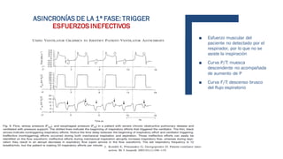 ■ Esfuerzo muscular del
paciente no detectado por el
respirador, por lo que no se
asiste la inspiración
■ Curva P/T: muesca
descendente no acompañada
de aumento de P
■ Curva F/T: descenso brusco
del flujo espiratorio
ASINCRONÍAS DE LA 1ª FASE: TRIGGER
ESFUERZOSINEFECTIVOS
 