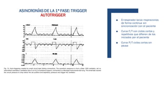 ■ El respirador lanza inspiraciones
de forma continua sin
sincronización con el paciente
■ Curva F/T con ciclos cortos y
repetitivos que difieren de los
iniciados por el paciente
■ Curva P/T ciclos cortos sin
pausa
ASINCRONÍAS DE LA 1ª FASE: TRIGGER
AUTOTRIGGER
 