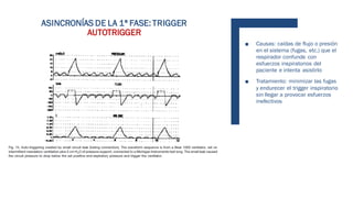 ASINCRONÍAS DE LA 1ª FASE: TRIGGER
AUTOTRIGGER
■ Causas: caídas de flujo o presión
en el sistema (fugas, etc.) que el
respirador confunde con
esfuerzos inspiratorios del
paciente e intenta asistirlo
■ Tratamiento: minimizar las fugas
y endurecer el trigger inspiratorio
sin llegar a provocar esfuerzos
inefectivos
 