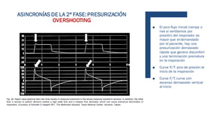 ■ El pico flujo inicial (rampa o
rise si ventilamos por
presión) del respirador es
mayor que el demandado
por el paciente, hay una
presurización demasiado
rápida que genera disconfort
y una terminación prematura
en la inspiración
■ Curva P/T: pico de presión al
inicio de la inspiración
■ Curva F/T: curva con
ascenso demasiado vertical
al inicio
ASINCRONÍAS DE LA 2ª FASE: PRESURIZACIÓN
OVERSHOOTING
 