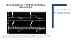 ASINCRONÍAS DE LA 2ª FASE: PRESURIZACIÓN
OVERSHOOTING
■ Causas: pico-flujo excesivo
■ Tratamiento: disminuir el
pico de flujo inspiratorio
 