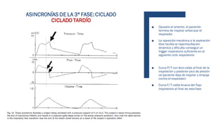 ■ Opuesto al anterior, el paciente
termina de inspirar antes que el
respirador
■ La oposiciónmecánica a la espiración
libre facilita la hiperinsuflación
dinámica y dificulta conseguir un
trigger inspiratorio suficiente en el
siguiente ciclo respiratorio
■ Curva P/T con leve caída al final de la
inspiración y posterior pico de presión
(el paciente deja de inspirar y empuja
contra el respirador)
■ Curva F/T caída brusca del flujo
inspiratorio al final de esta fase
ASINCRONÍAS DE LA 3ª FASE: CICLADO
CICLADO TARDÍO
 