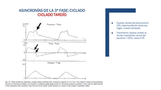 ASINCRONÍAS DE LA 3ª FASE: CICLADO
CICLADO TARDÍO
■ Causas: exceso de presurización
(PS), hiperinsuflación dinámica,
fugas, ciclado retrasado
■ Tratamiento: Ajustar ciclado al
tiempo inspiratorio neural del
paciente (>30%), reducir PS
 